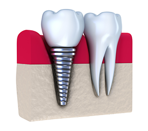Dental Implants | Dentist in Chevy Chase, MD | Chevy Chase Cosmetic & Implant Dentistry